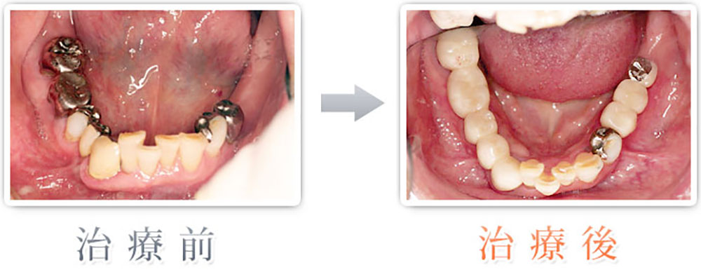 治療症例：銀歯をセラミック、左下2本をインプラント