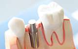 岡山歯医者のインプラント治療